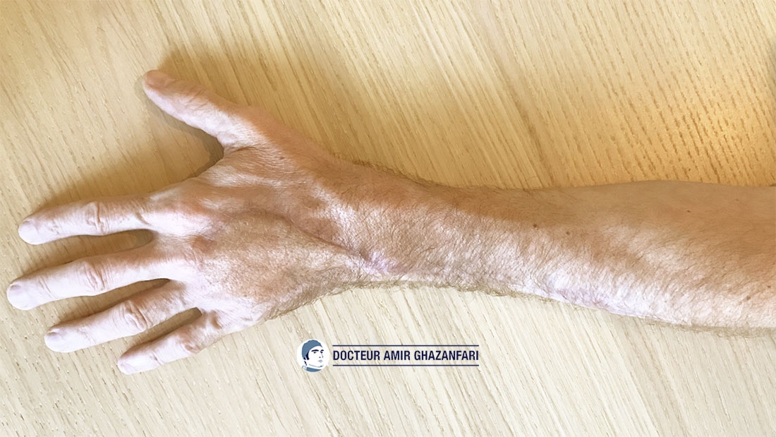 Image 3 Lambeaux - Exemple d'une nécrose étendu du dos de la main, couvert par un leambeau prélévé sur l'avant bras qui est tourné de 180° afin de couvrir la main