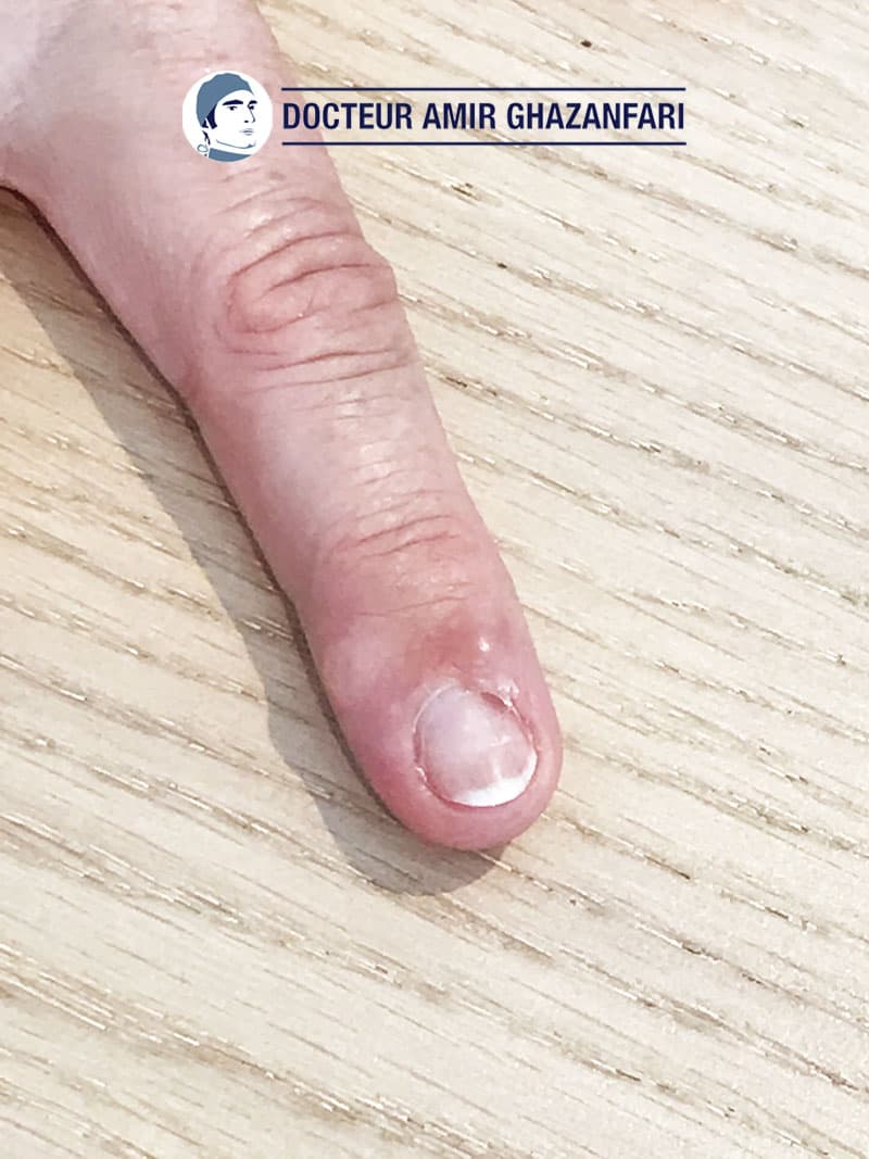 Kyste mucoîde - Figure 2. Kyste mucoïde avec déformation de l'ongle en regard