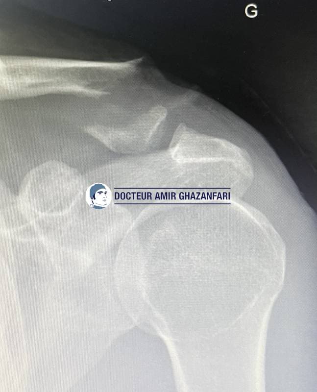 Image 1 Fracture de clavicule - Figure 6. Fracture déplacée du quart externe de la clavicule. Aspect post-opératoire après réduction et mise en place de DogBones sous arthroscopie.